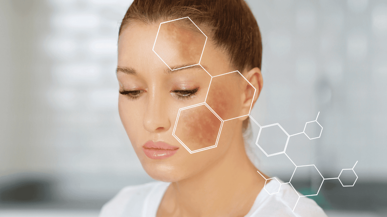 The Role of Zinc Picolinate in Reducing Dark Spots, girl with hyperpigmentation